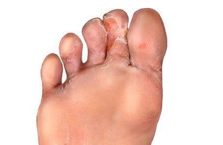 Athlete's Foot